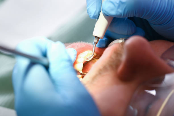 Best Dentist for Tooth Abscess  in Monticello, NY